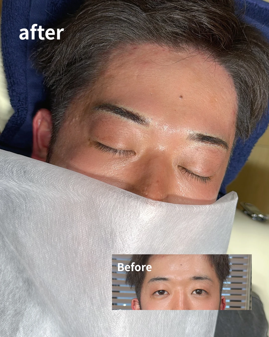 眉アートメイクの症例写真（Before/After）